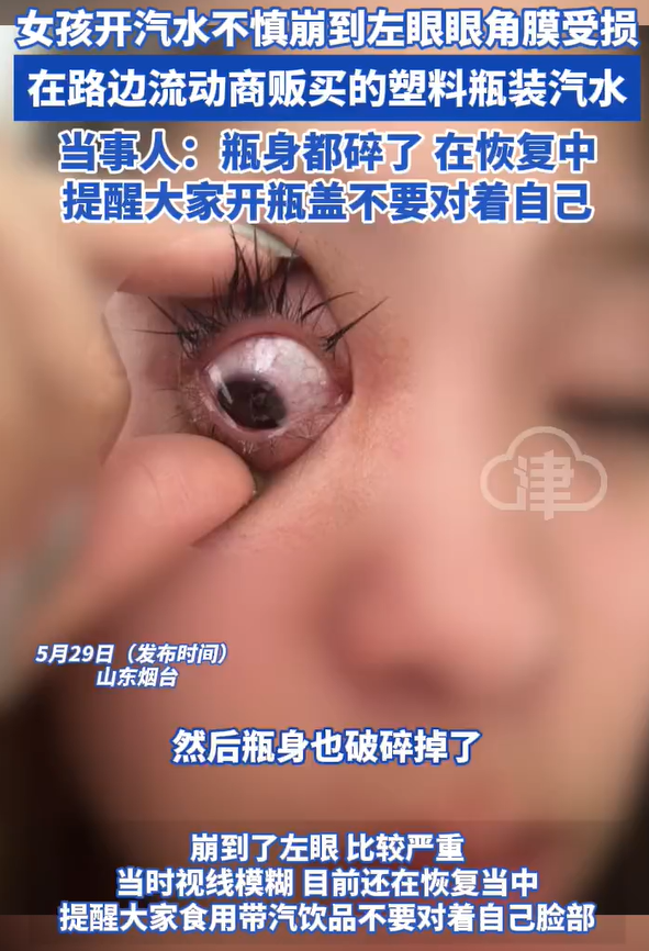 女孩开汽水崩到眼睛角膜受损提醒开瓶注意安全！(图2)